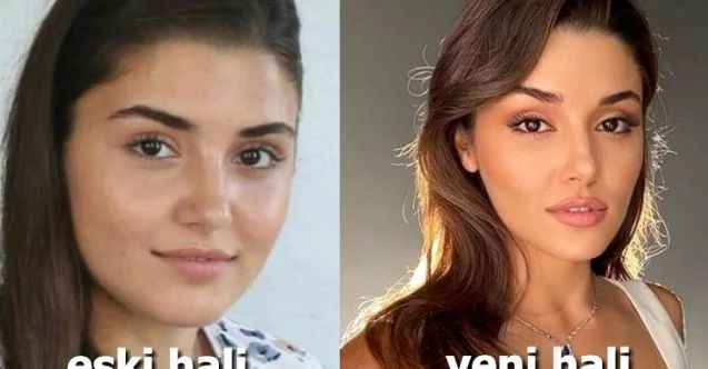 Hande Erçel Estetik Yaptırdı mı? Ünlü Oyuncu Sinirlerine Hakim Olamadı