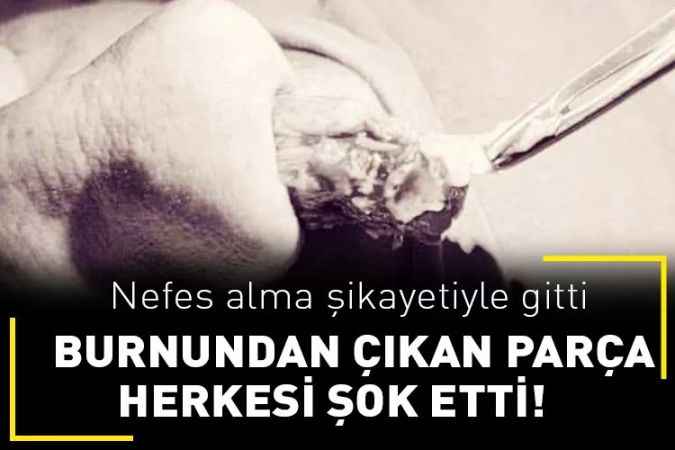 Yozgat Şehir Hastanesinde nefes almakta güçlük çeken bir hastaya yapılan ameliyat da büyüklüğü 8 santimetre olan kitle tek parça olarak çıkarıldı