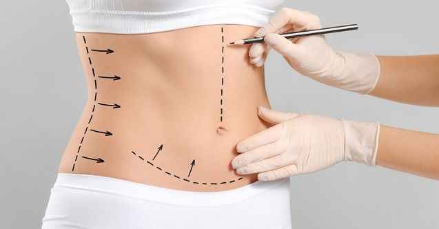 Karın Germe Ameliyatı (Abdominoplasty)