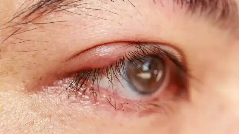Gözde İt Dirseği Neden Çıkar?