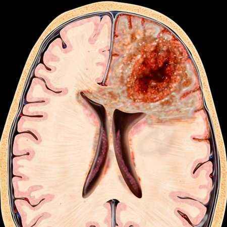 Glioblastoma Nedir?