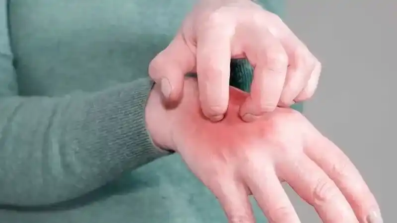 Uyuz Hastalığı Nedir? Belirtileri Neler?
