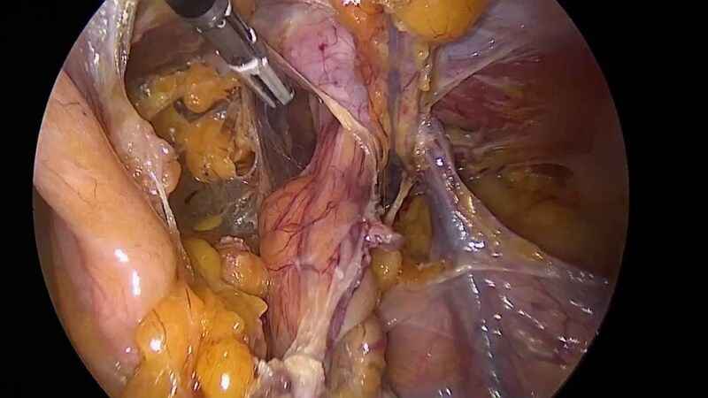 Giant İnguinal Hernia Nedir?