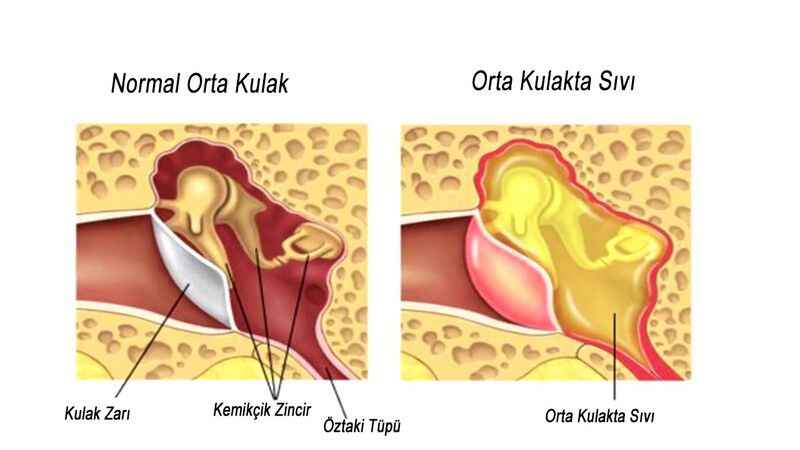 Orta Kulak İltihabı Rahatsızlıkları: Otit Nedir, Otit Nasıl Tedavi Edilir?