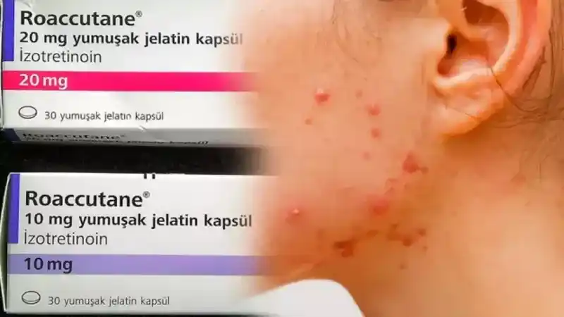 Roaccutane nedir, nasıl kullanılır?