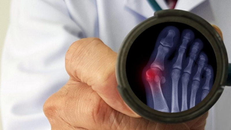 Ayak Sağlığınızı Tehlikeye Atmayın! Bunyon (Halluks Valgus) Nedir ve Nasıl Tedavi Edilir? İşte Bilmeniz Gereken Her Şey!