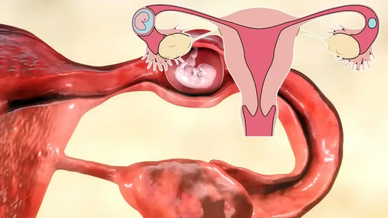 Dış Gebelik Nedir? Dış Gebeliğin Tanımı ve Türleri