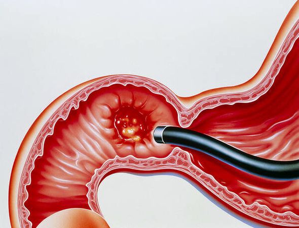 Gastrit Nedir?