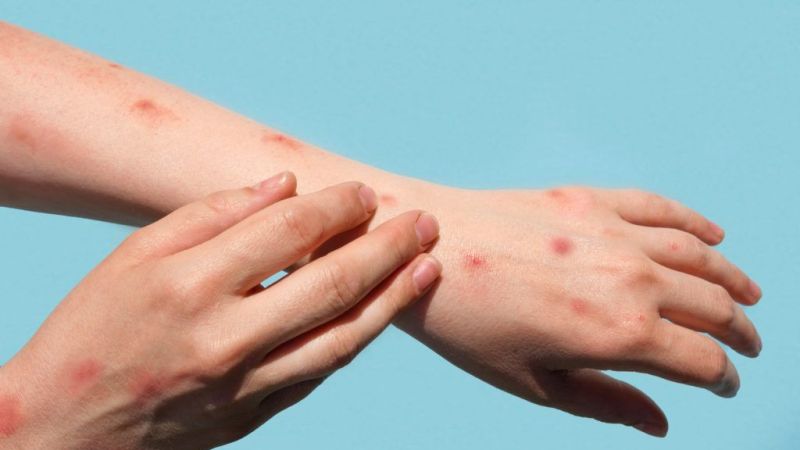 Dünya'da Acil Durum İlan Edildi! Maymun Çiçeği Virüsü Nedir? Belirtileri Nelerdir?
