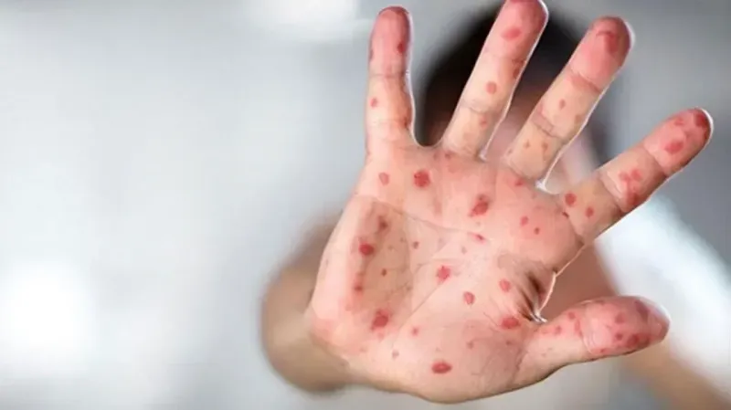 Maymun Çiçeği Tehlikesi Büyüyor! Virüs İçin Bakanlıktan Acil Kılavuz