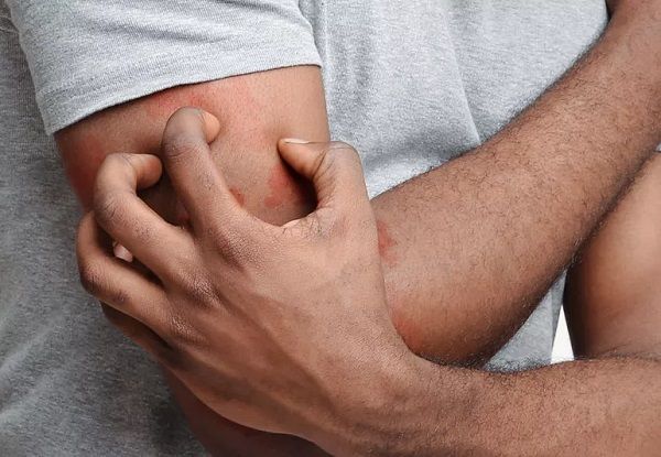 Yozgat'ta Bu Belirtiler Olursa Doktora Koşun! Hayalet Hastalık Lyme'a 300 Hastalığı Taklit Ediyor