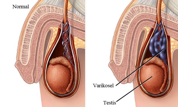 Varikosel nedir?