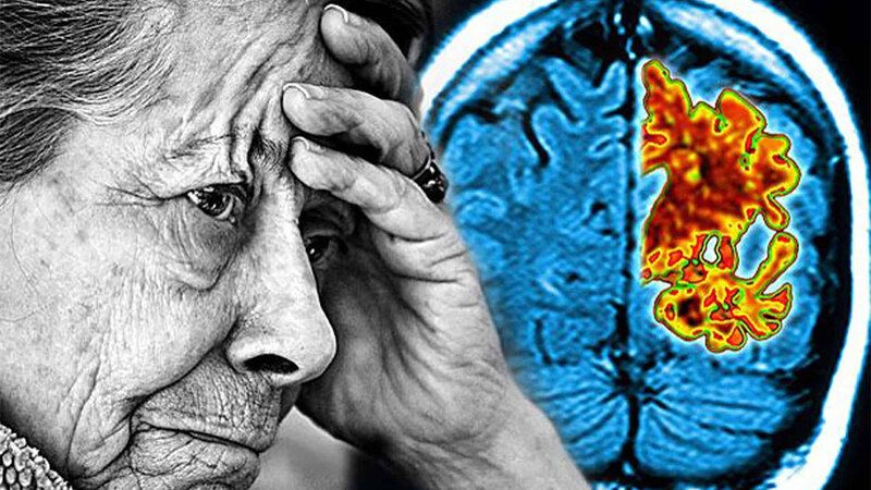 Yozgat'ta Alzheimer Hastalığına Dikkat! Önlemler Hayati Önem Taşıyor