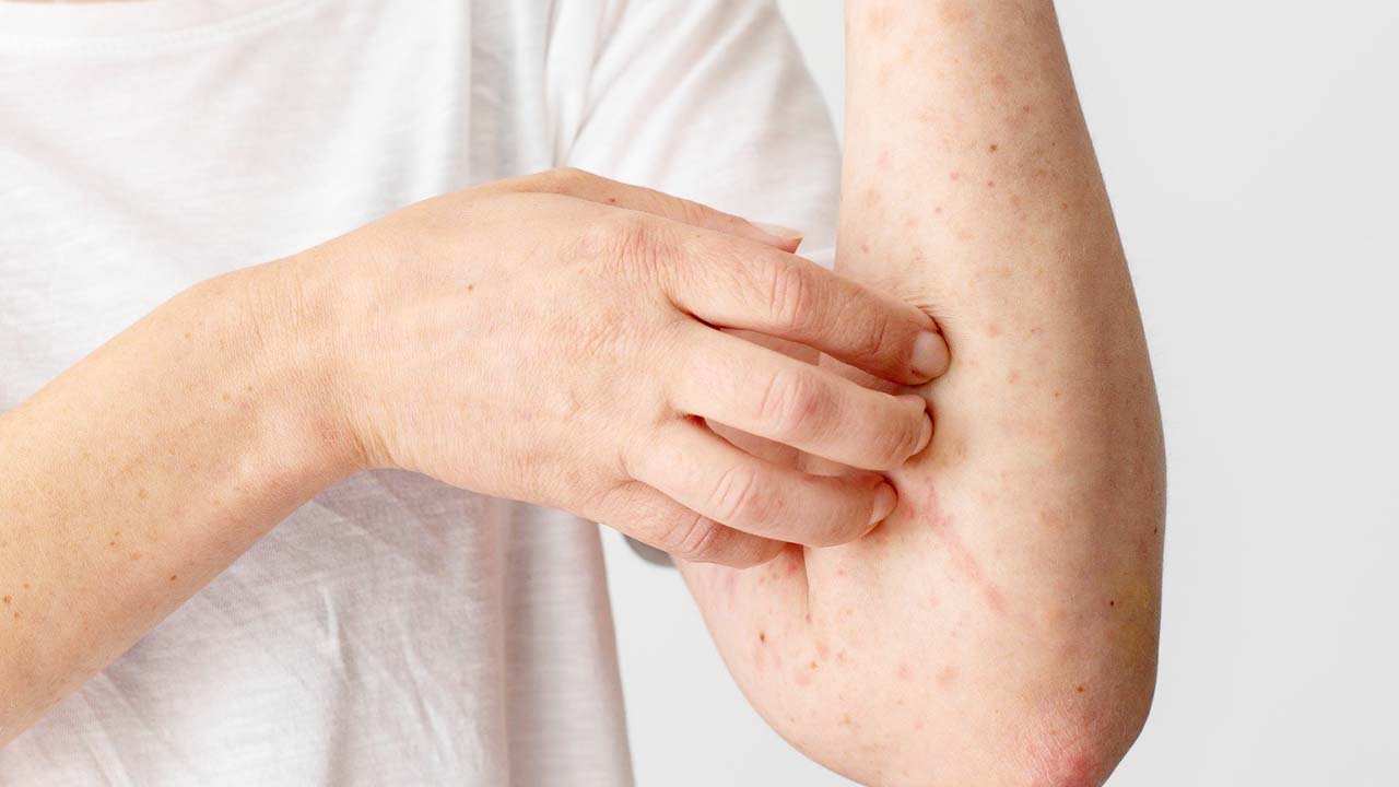 Dermatologlar Uyardı: Stres Zona Hastalığını Tetikliyor!