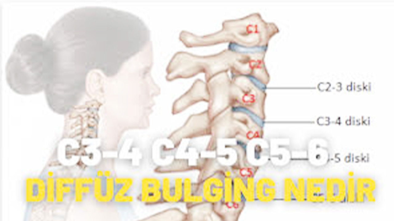 C3-4 C4-5 C5-6 Diffüz Bulging Nedir