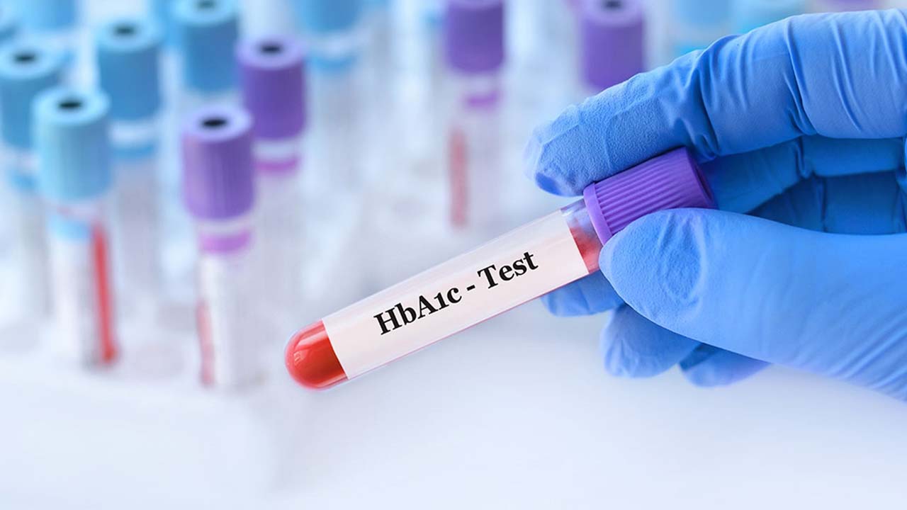 Glikolize Hemoglobin (Hb A1c) Nedir