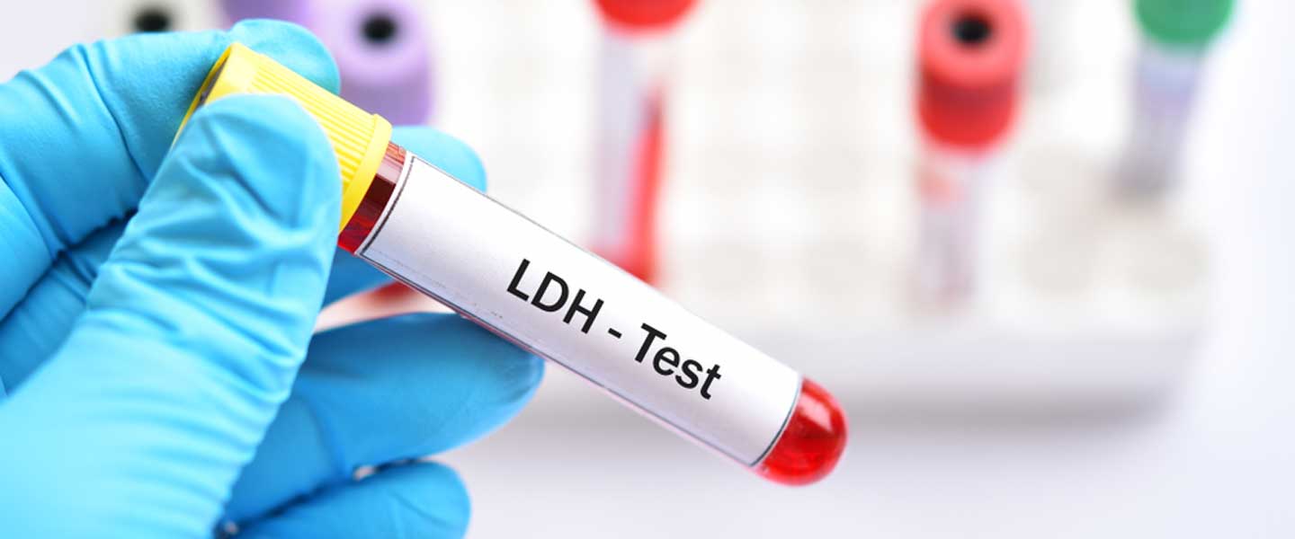 Laktat Dehidrogenaz Yüksekliği Nedir