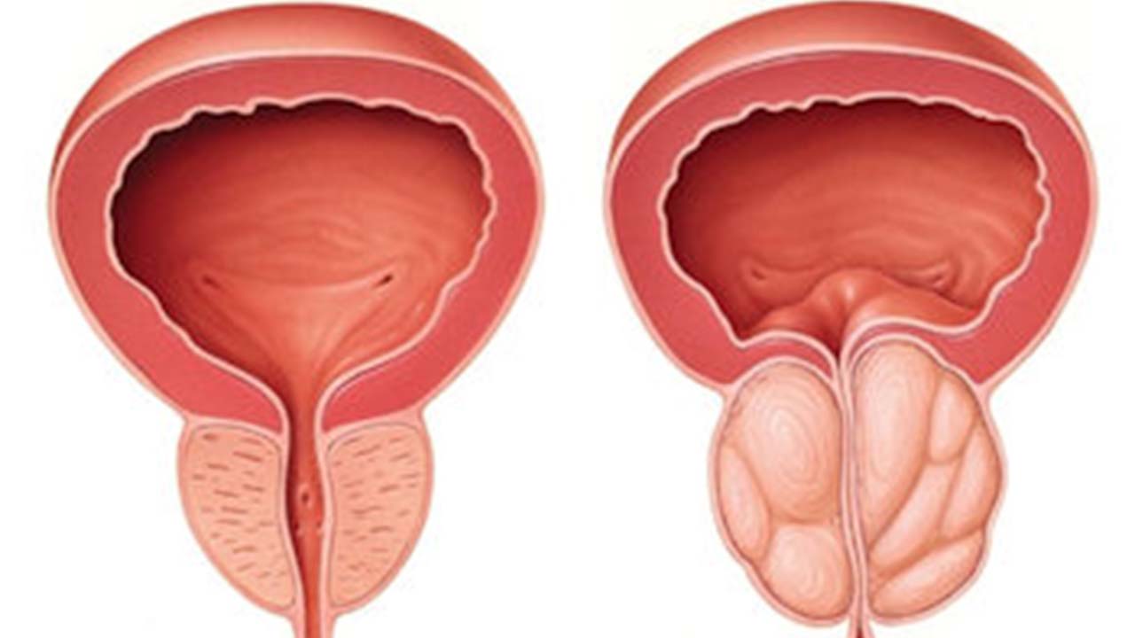 Benign Prostat Hiperplazisi Nedir