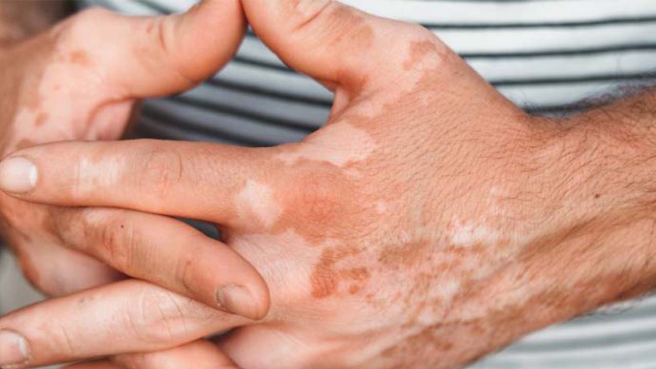 Vitiligo Olmayan Beyaz Lekeler Nedir