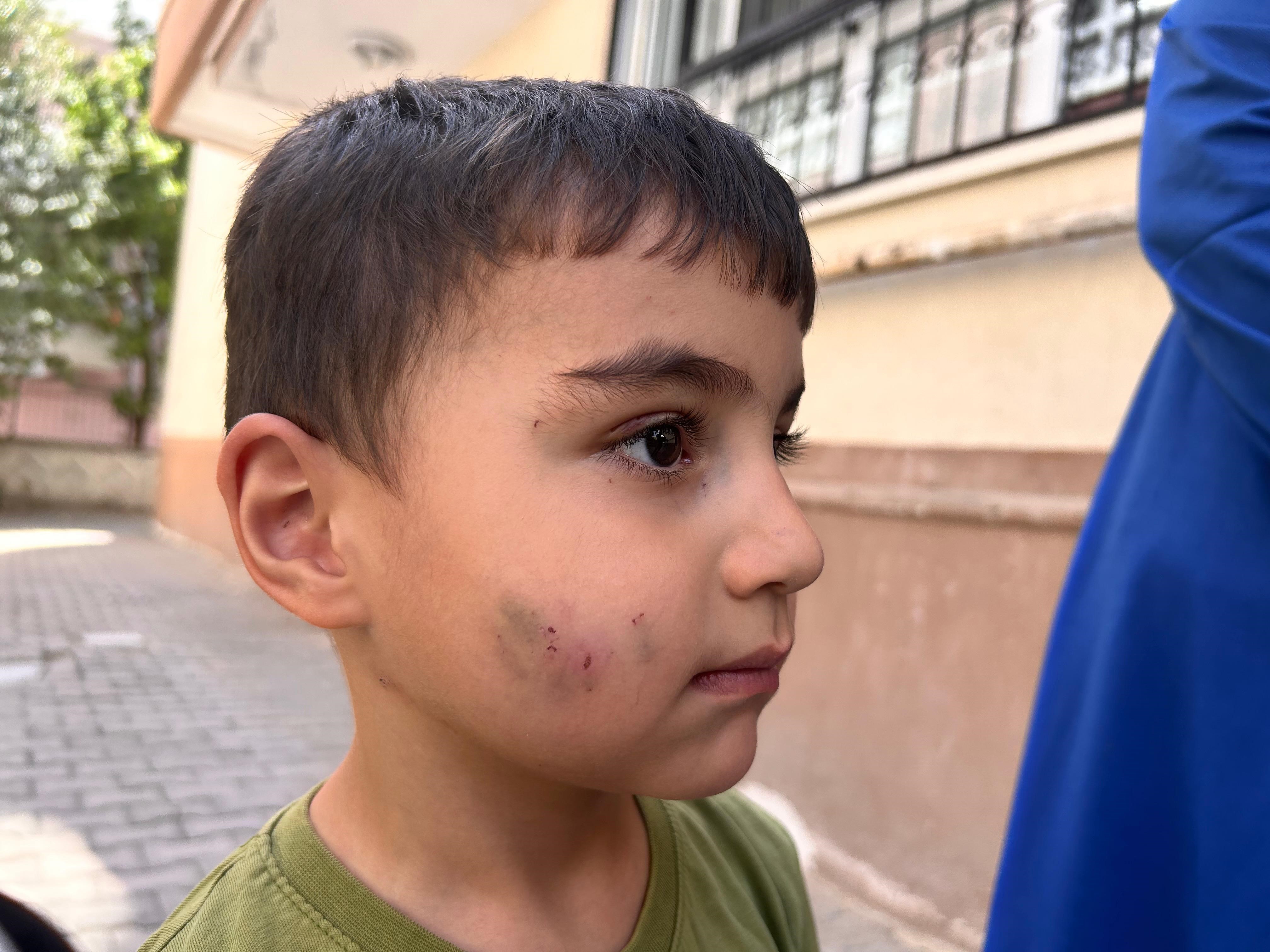 Ankara Sincan’da Evde Uyuyan Çocuğu Lağım Faresi Isırdı: Kuduz Aşısı Yapıldı, Aile İlaçlama Bekliyor