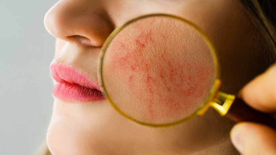 Sistemik Lupus Eritematozus Nedir