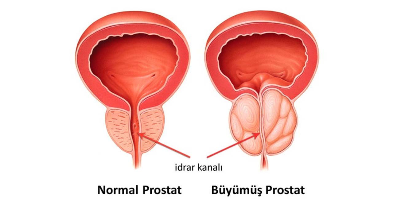 Prostat (3)